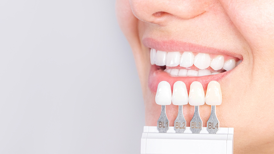 Strahlend weiße Zähne mit Shade Guide für Bleaching zum Abgleich der perfekten Farbe