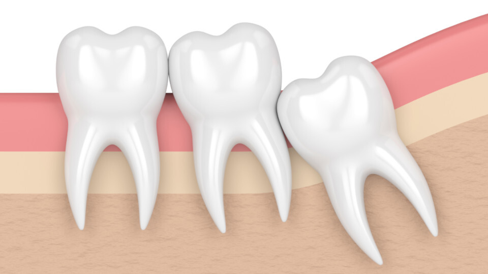 Ein schief liegender Weisheitszahn