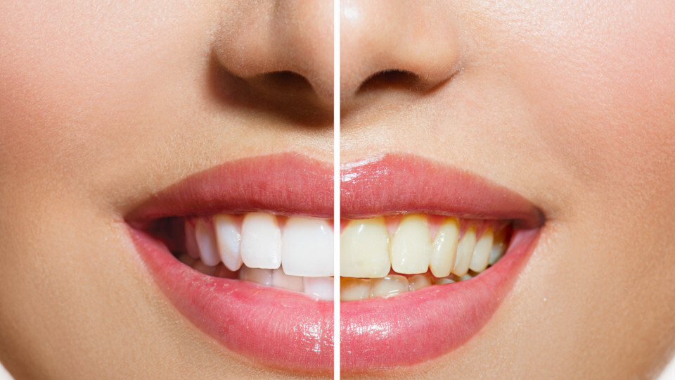 Eine Frau mit weißen und verfärbten Zähnen